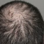 Dealing with hair loss