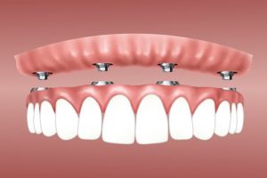 overdenture implant